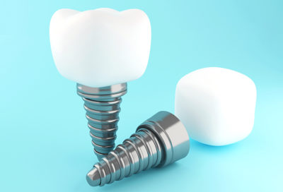 A 3D image of two dental implants on a blue background