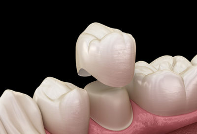 3D illustration of a dental crown being placed over tooth