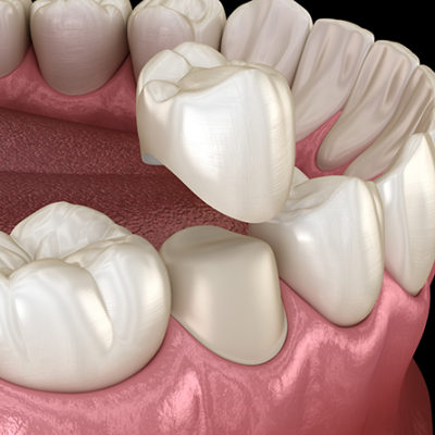 3D image of a dental crown being placed over a small tooth