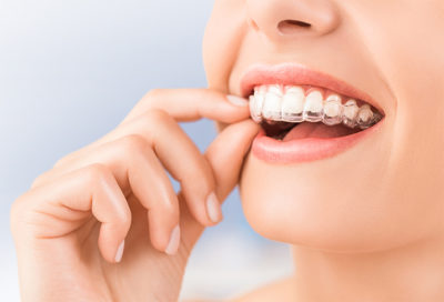 A woman puts on Invisalign.