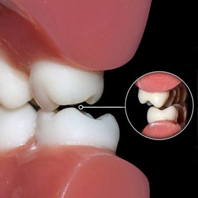 A close-up image of molars grinding