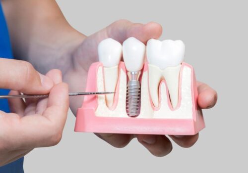 The Making of New Smiles: Our Dental Implants Project in Calgary