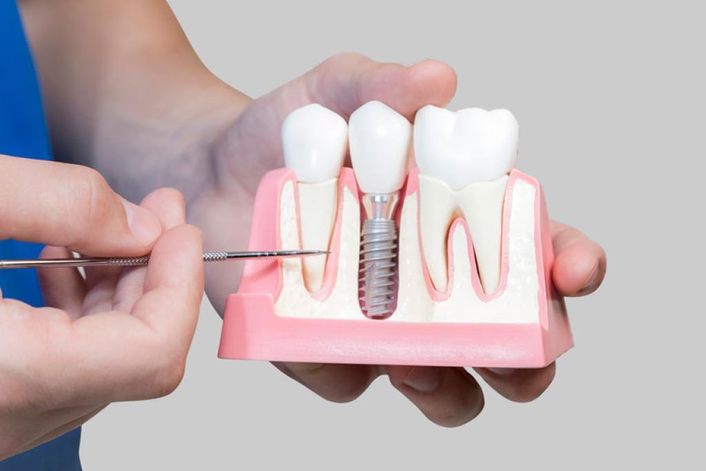 The Making of New Smiles: Our Dental Implants Project in Calgary