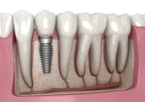 The Making of New Smiles: Our Dental Implants Project in Calgary