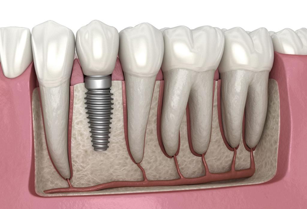 The Making of New Smiles: Our Dental Implants Project in Calgary