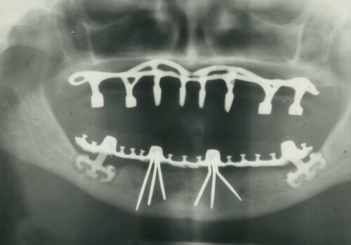 The Making of New Smiles: Our Dental Implants Project in Calgary