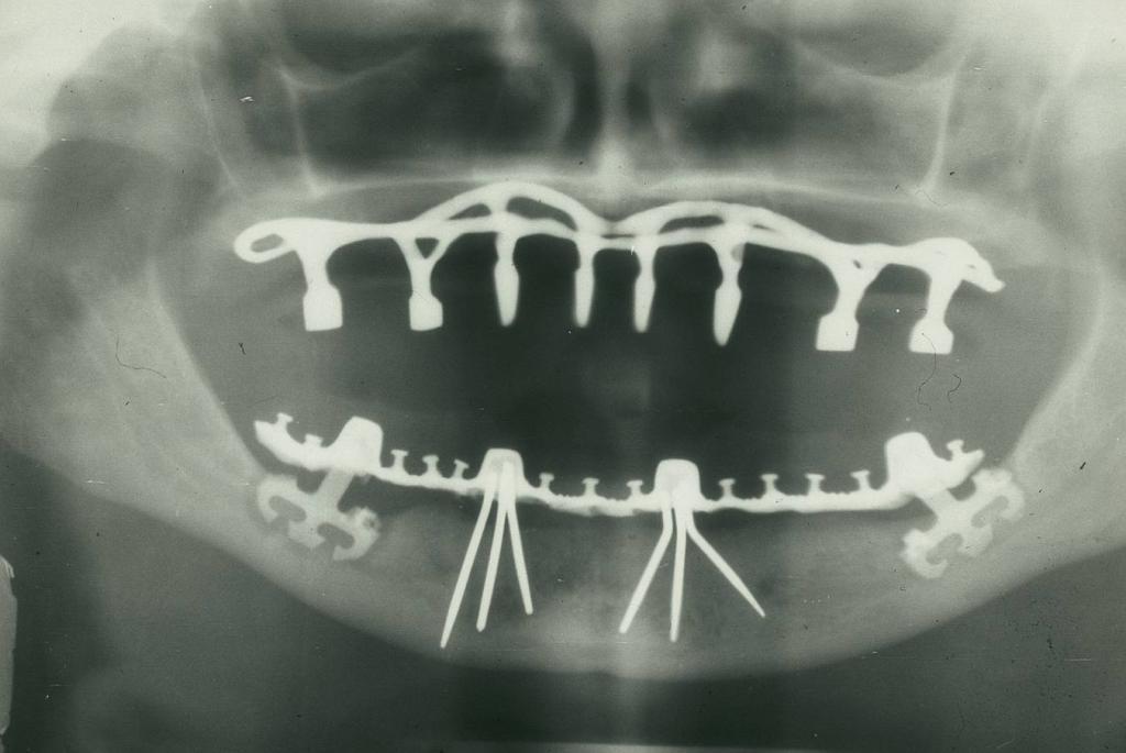 The Making of New Smiles: Our Dental Implants Project in Calgary