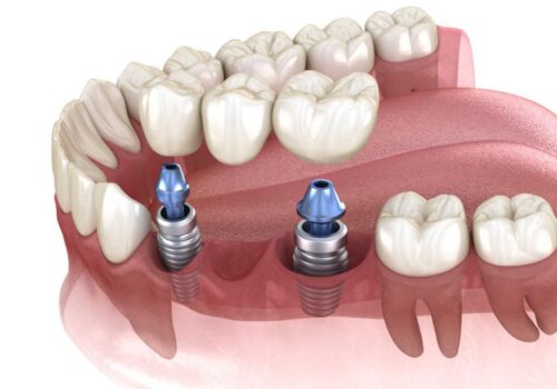 The Making of New Smiles: Our Dental Implants Project in Calgary