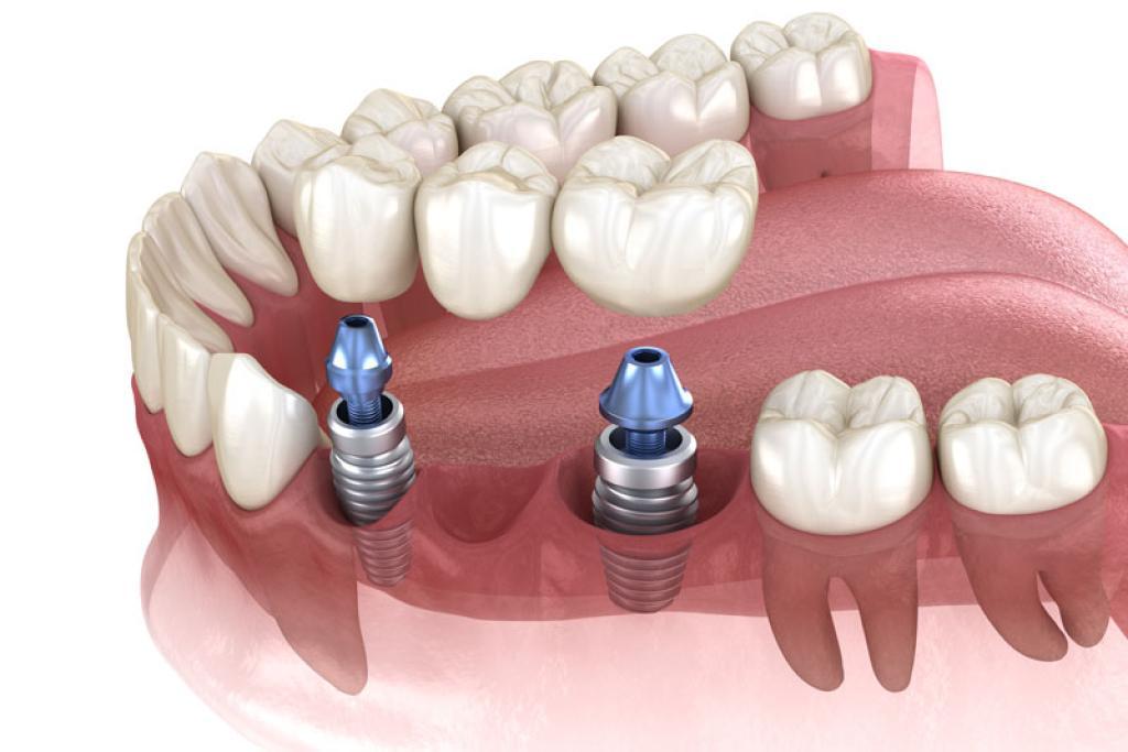 The Making of New Smiles: Our Dental Implants Project in Calgary