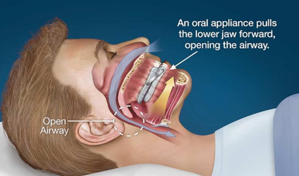 Improving Lives: Our Sleep Apnea Clinic in Calgary